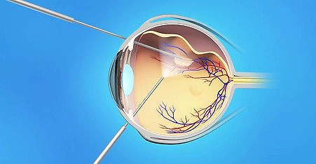 Retina Animation: Detached Retina Vitrectomy